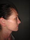 Developing a little bump of nose bridge. (7 wks post-op)