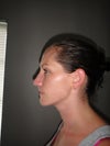 Developing a little bump of nose bridge. (7 wks post-op)