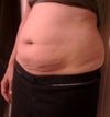 5 weeks postpardum, plan on waiting 6 months for surgery.