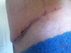 font view of TT incision 12 days post op

 under the muscle implants size replaced and reduced along with lift/reduction