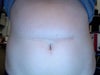 What the scar looks like now without any revisions or surgical procedures to correct this.