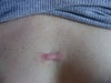 scar, looks little more red in rel life, about 3 sm x 1 cm