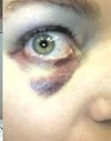 Right eye- doctor hit a vessel (she knew as soon as she hit it!)