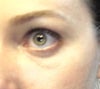 left eye w/ slight bulge