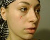 I marked the photo with the problem areas and my ideal cheek fullness.