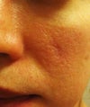 acne scar, left cheek