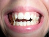 Before braces, my teeth were crooked on the bottom after a baby tooth was removed on that side.