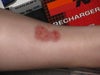 This is the overhead view of the scar. It's on my right leg