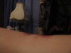 This is a side view. You can just slightly see a dip in my skin from this.