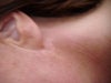 white scaring behind both ears was due to face lift as i have
  lost a few pounds scaring seems to have become more 
  visible.what treatment would be best to remove white scaring
  if laser could you recommend best one.



  regards