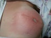 This is a better shot of the infection.