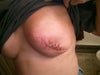 This is what the breast still looks like. It is much bigger than the other.
