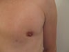 depression caused by slight muscle flex