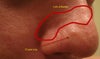 12 Year Scar. Hyperplasia bumps on this side.