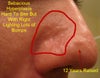 12 Year Scar. Hyperplasia bumps on this side.