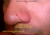 smaller fresher scar 3 month old.  need to fix texture of skin. huge pores