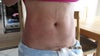 3 days after procedure front view