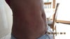 3 days after procedure 3/4 view
