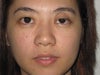 Hollow eyelid due to failed ptosis repair
