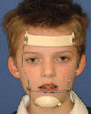 a boy with orthopedic device