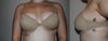 1 cup of rice in my bra. This is how I would like to look.