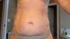 This is a pic prior to my tummy tuck for comparison.  I am 5'6" tall and 118 lbs.