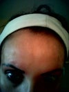 Front scar