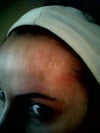 Left side scar