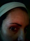 right side scar