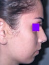 My 12th day post-op