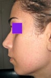 My 12th day post-op