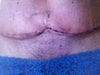 12 days post op