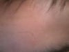 Scar on forehead