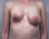 Before augmentation and lift