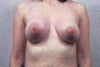 After augmentation and lift