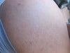 thicker hairs around my shoulder area after laser