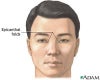 asians tend to have prominent epicanthal folds because of their flat nose bridges