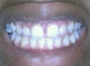 The Front teeth