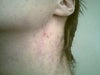 Its less red and more light pink now, but this is a good picture detailing what it looks like.