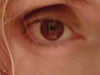 after blepharoplasty