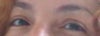 2 months before blepharoplasty