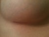 Right fold/incision - spot on.