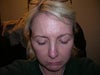 Cheek fat transfer