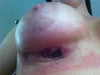Right breast