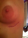 Left breast after explantation