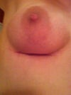 Right breast after explantation
