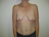 Before frontal