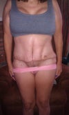 Post-op 9 days