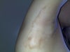 Right arm burnt area
