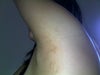 left arm burnt area